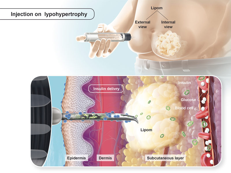 LYPODISTROPHIE