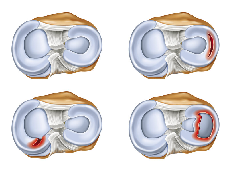 LÉSION MÉNISCALE