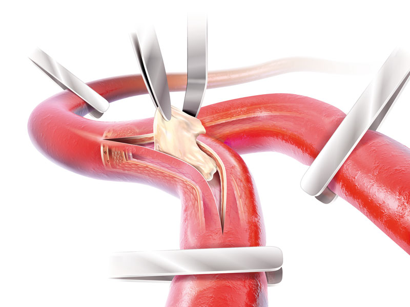 Ectomie du Thrombus