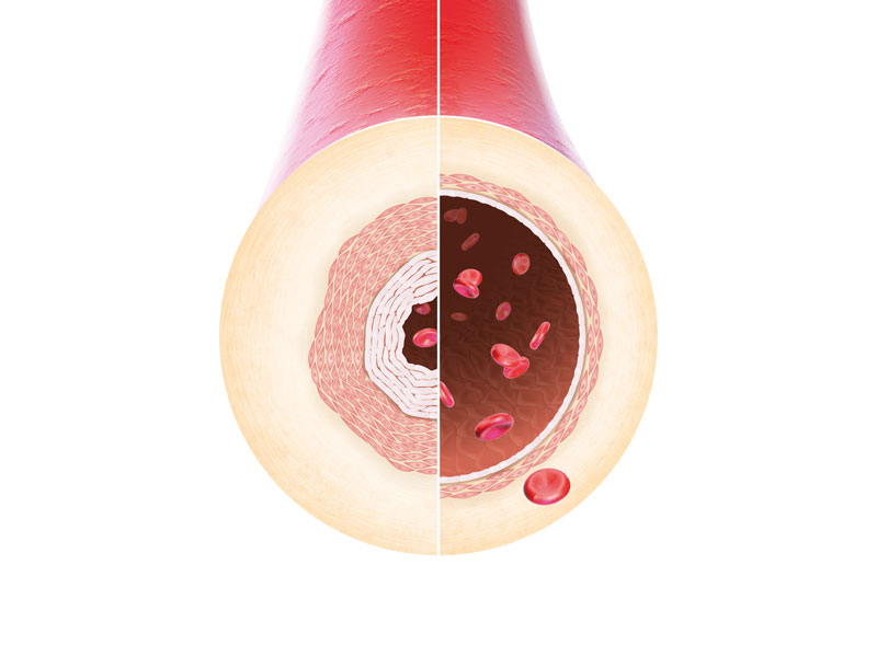 Hypertension pulmonaire