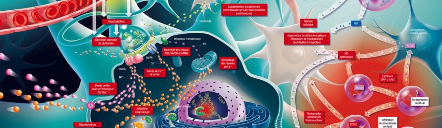 illustration-medicale-didactique-scientifique-AVC-AIT-accident-vasculaire-cerebral