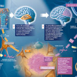 illustration-medicale-scientifique-didactique-alzheimer-cerveau-neurone