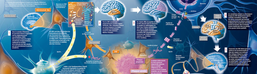 illustration-medicale-scientifique-didactique-alzheimer-cerveau-neurone