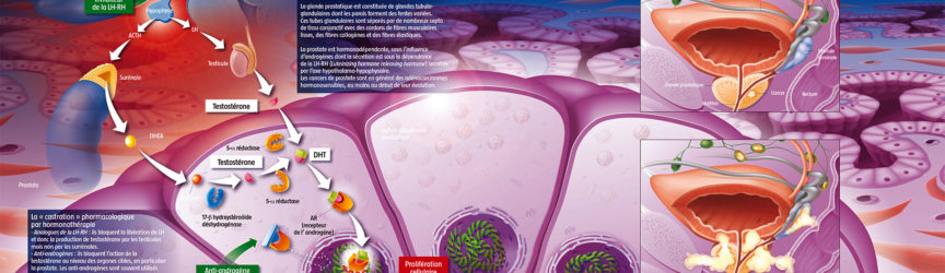 illustration-medicale-scientifique-didactique-cancer-prostate