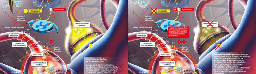 illustration-medicale-scientifique-didactique-neuropathie