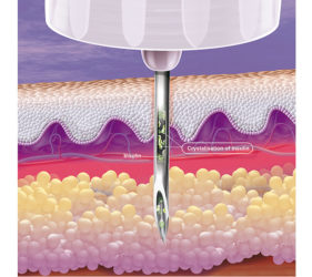 illustration-medicale-scientifique-3D-lypohypertrophy-lypodistrophie-reutilisation-aiguille-1