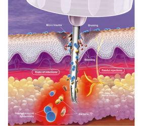 illustration-medicale-scientifique-3D-lypohypertrophy-lypodistrophie-reutilisation-aiguille-4