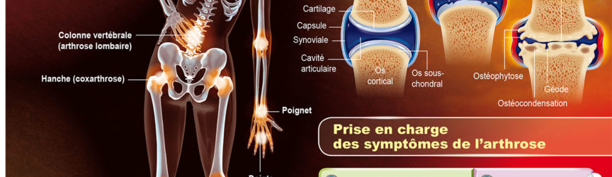 illustration-medicale-scientifique-arthrose-articulations