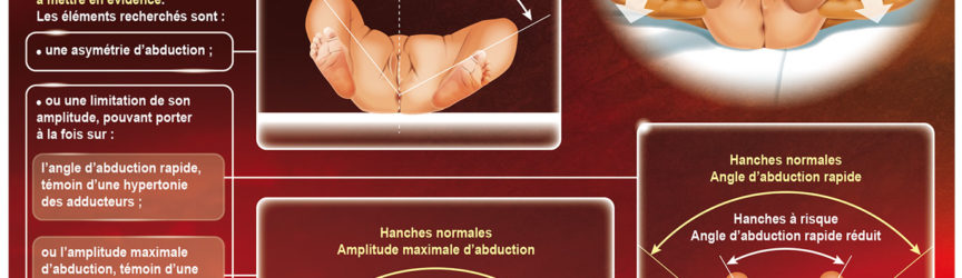 illustration-medicale-scientifique-depistage-luxation-hanche