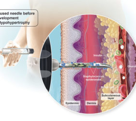 illustration-medicale-scientifique-lipohypertrophy-lypodistrophie-insulin-epidermis-dermis-glucose-blood-cell-00