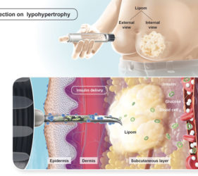 illustration-medicale-scientifique-lipohypertrophy-lypodistrophie-insulin-epidermis-dermis-glucose-blood-cell-02