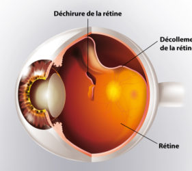 illustration-medicale-scientifique-ramsay-retine-decollement-vision-opthalmologie