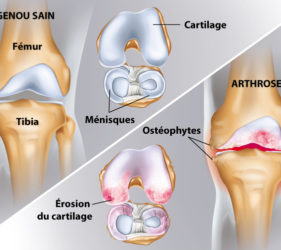 illustration-medicale-scientifique-ramsay-arthrose-genou-gonarthrose-cartilage