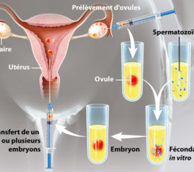 illustration-medicale-scientifique-ramsay-assistance-medicale-procreation-amp