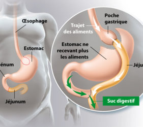 illustration-medicale-scientifique-ramsay-bypass-gastrique-estomac-circuit-alimentaire-operation-chirurgicale