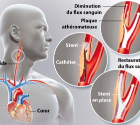 illustration-medicale-scientifique-ramsay-carotides-stent-endarterdectomie-infarctus-cerebral