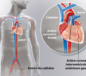 illustration-medicale-scientifique-ramsay-coronarographie-artere-coronaire