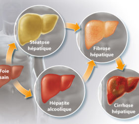 illustration-medicale-scientifique-ramsay-foie-alcool-cirrhose-hepatique