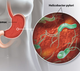 illustration-medicale-scientifique-ramsay-helicobacter-pylori-bacterie-ulcere-estomac-duodenome