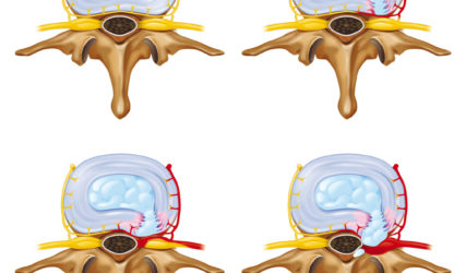 illustration-medicale-scientifique-ramsay-hernie-discale-disque-vertebre