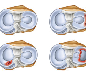 illustration-medicale-scientifique-ramsay-lesion-meniscale-menisque-genou-femur-tibia-cartilage