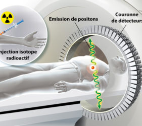 illustration-medicale-scientifique-ramsay-PET-scan-tumeurs-metastase-cancer