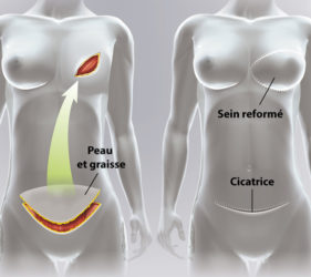 illustration-medicale-scientifique-ramsay-reconstruction-mammaire-chirurgie