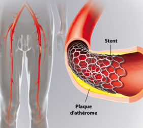 illustration-medicale-scientifique-ramsay-stent-peripherique-jambe-fonctionnement-vasculaire