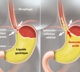 illustration-medicale-scientifique-ramsay-reflux-grastrique