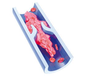 Vue en coupe d'une veine lors de la formation d'un thrombus.