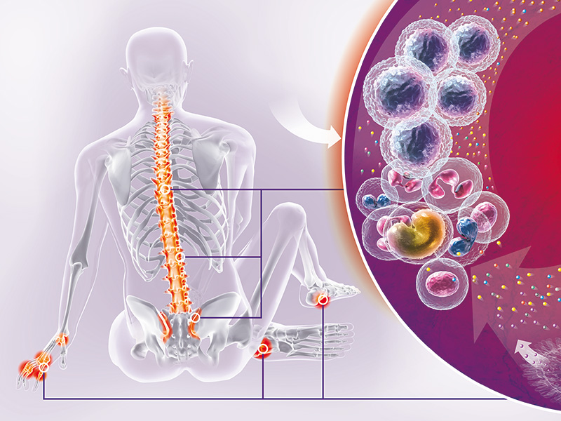 Spondylarthrites