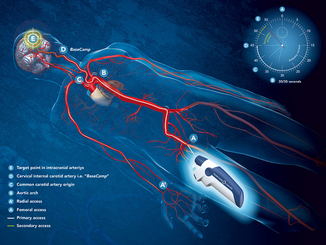 Navigation endo-vasculaire